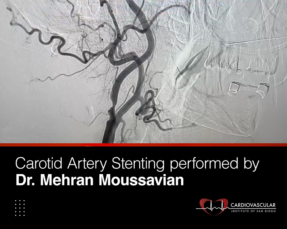 Carotid Artery Stenting Performed By Dr Mehran Moussavian