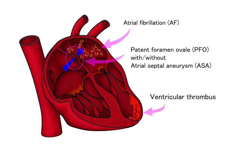 PFO Successfully Closed by Dr. Mehran Moussavian - Cardiovascular ...