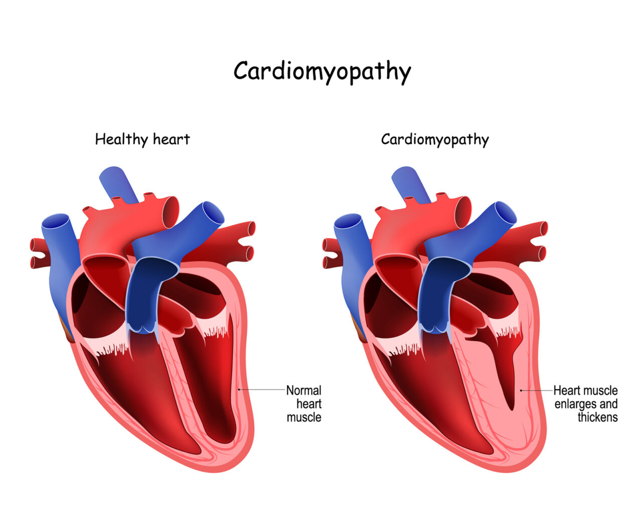 Hypertrophic Cardiomyopathy Management - Cardiovascular Institute Of ...